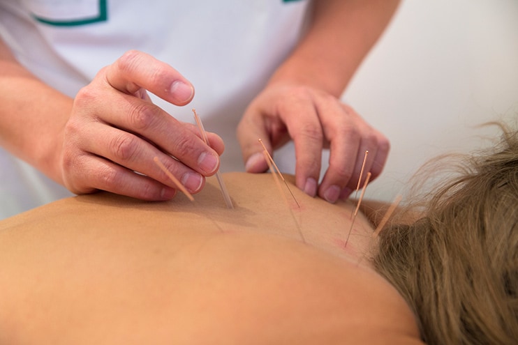 woman receiving acupuncture treatment by massage therapist