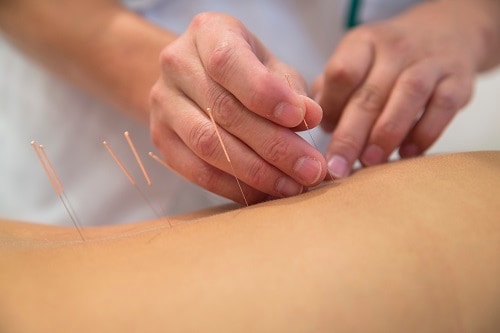therapist adding acupuncture needles on back of a young woman